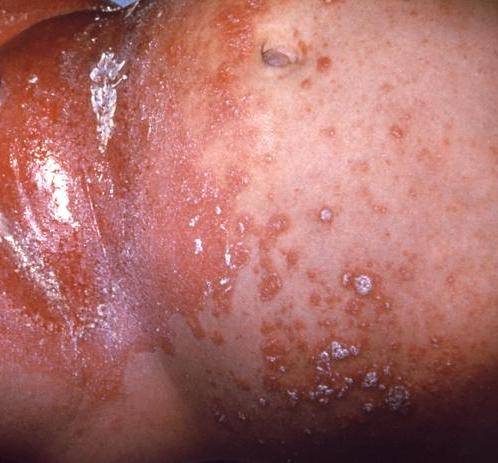 staph in the vagina Old grannys naked